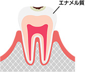 エナメル質のむし歯 (C1)