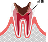 歯髄（神経）まで達したむし歯 (C3)